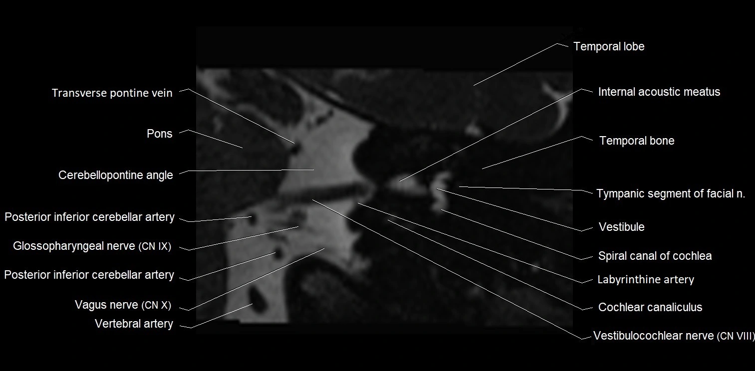 MRI Internal auditory meatus (IAM) coronal cross sectional labelled anatomy image 15.webp